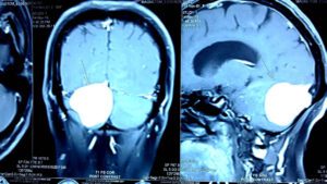 தலைவலி - வகைகள் & காரணம் - தீர்வு மருத்துவம்