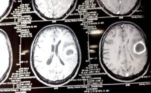 தலைவலி - வகைகள் & காரணம் - தீர்வு மருத்துவம்