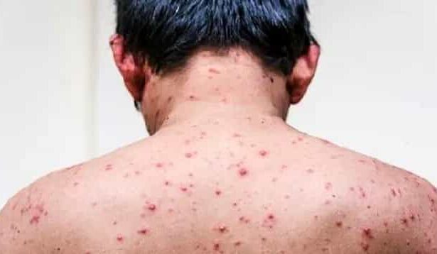 சின்னம்மை