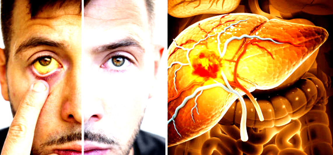 மஞ்சள் காமாலை நோய்த் தடுப்பு முறை- மருத்துவர் சு.நரேந்திரன் சிறப்பு நிலைப் பேராசிரியர், தமிழ்நாடு எம்.ஜி.ஆர். மருத்துவப் பல்கலைக்கழகம், தஞ்சாவூர்.